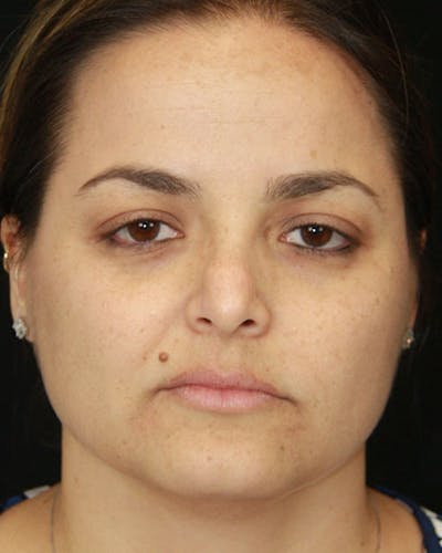 Revision Rhinoplasty Before & After Gallery - Patient 143521926 - Image 1