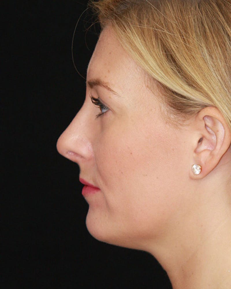 Rhinoplasty Before & After Gallery - Patient 143521916 - Image 10