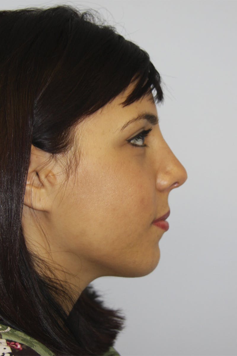 Chin Augmentation Before & After Gallery - Patient 143521924 - Image 4