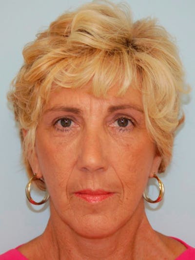 Eyelid Surgery Before & After Gallery - Patient 143521921 - Image 2