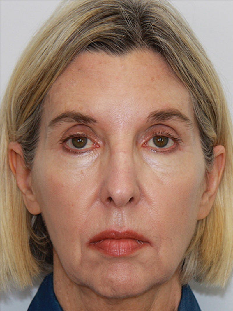 Facelift & Neck Lift Before & After Gallery - Patient 143521927 - Image 1