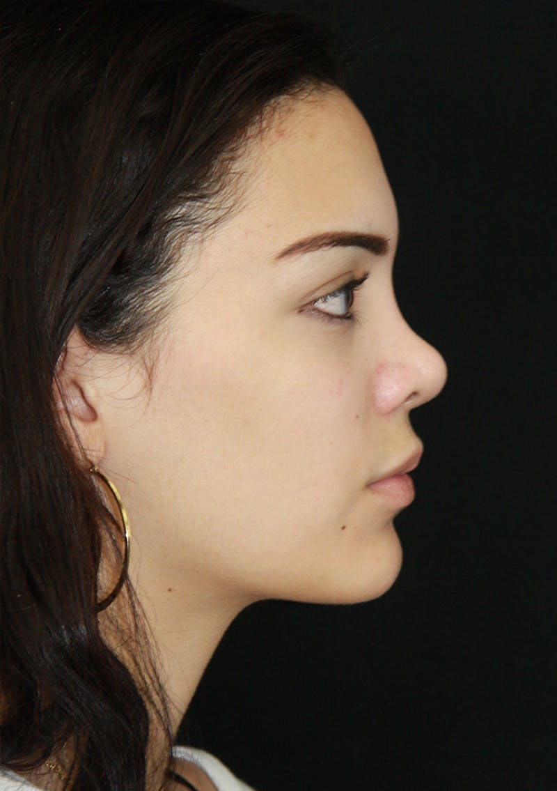 Non-Surgical Rhinoplasty Before & After Gallery - Patient 143521925 - Image 1