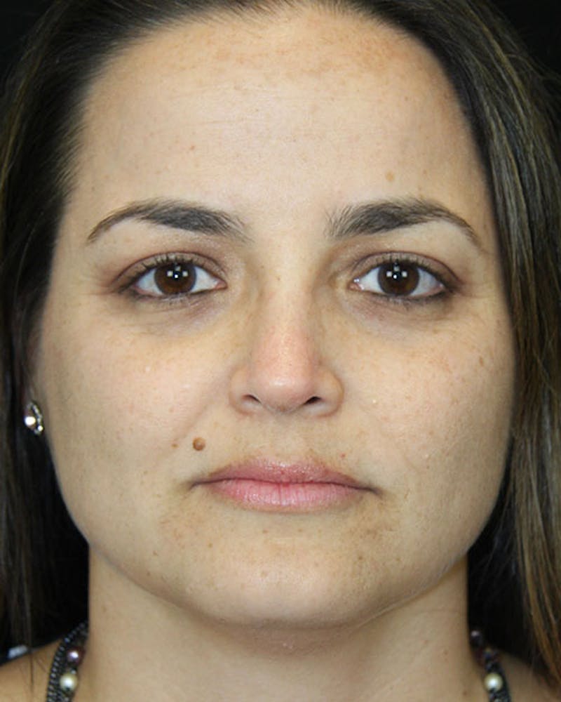 Revision Rhinoplasty Before & After Gallery - Patient 143521926 - Image 2