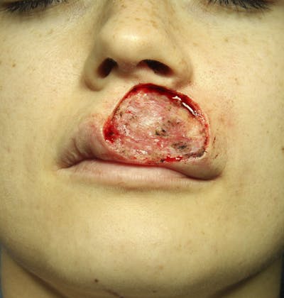 Mohs Reconstruction Before & After Gallery - Patient 143521920 - Image 1