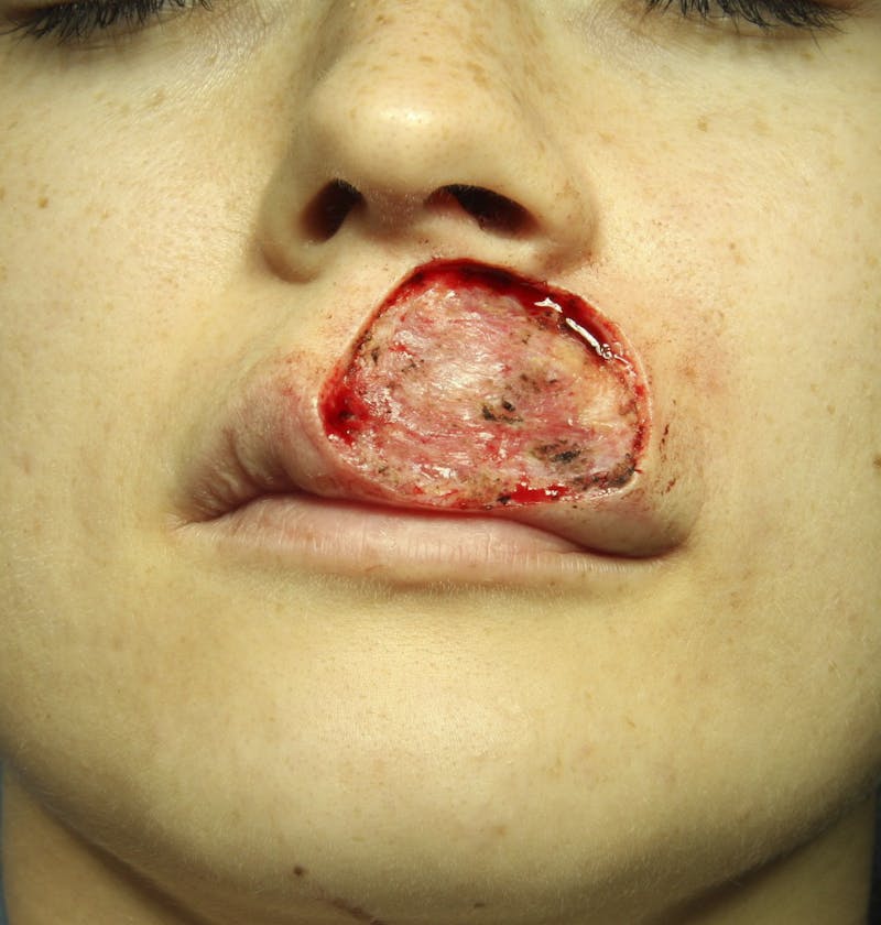 Mohs Reconstruction Before & After Gallery - Patient 143521920 - Image 1