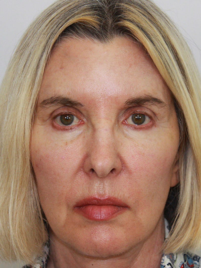 Facelift & Neck Lift Before & After Gallery - Patient 143521927 - Image 2