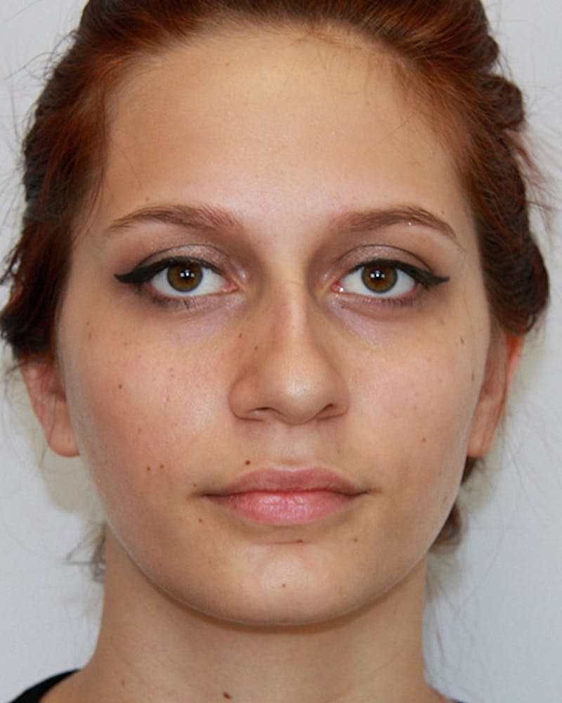 Rhinoplasty Before & After Gallery - Patient 143521929 - Image 1