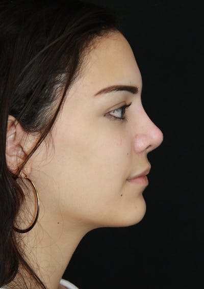 Non-Surgical Rhinoplasty Before & After Gallery - Patient 143521925 - Image 2