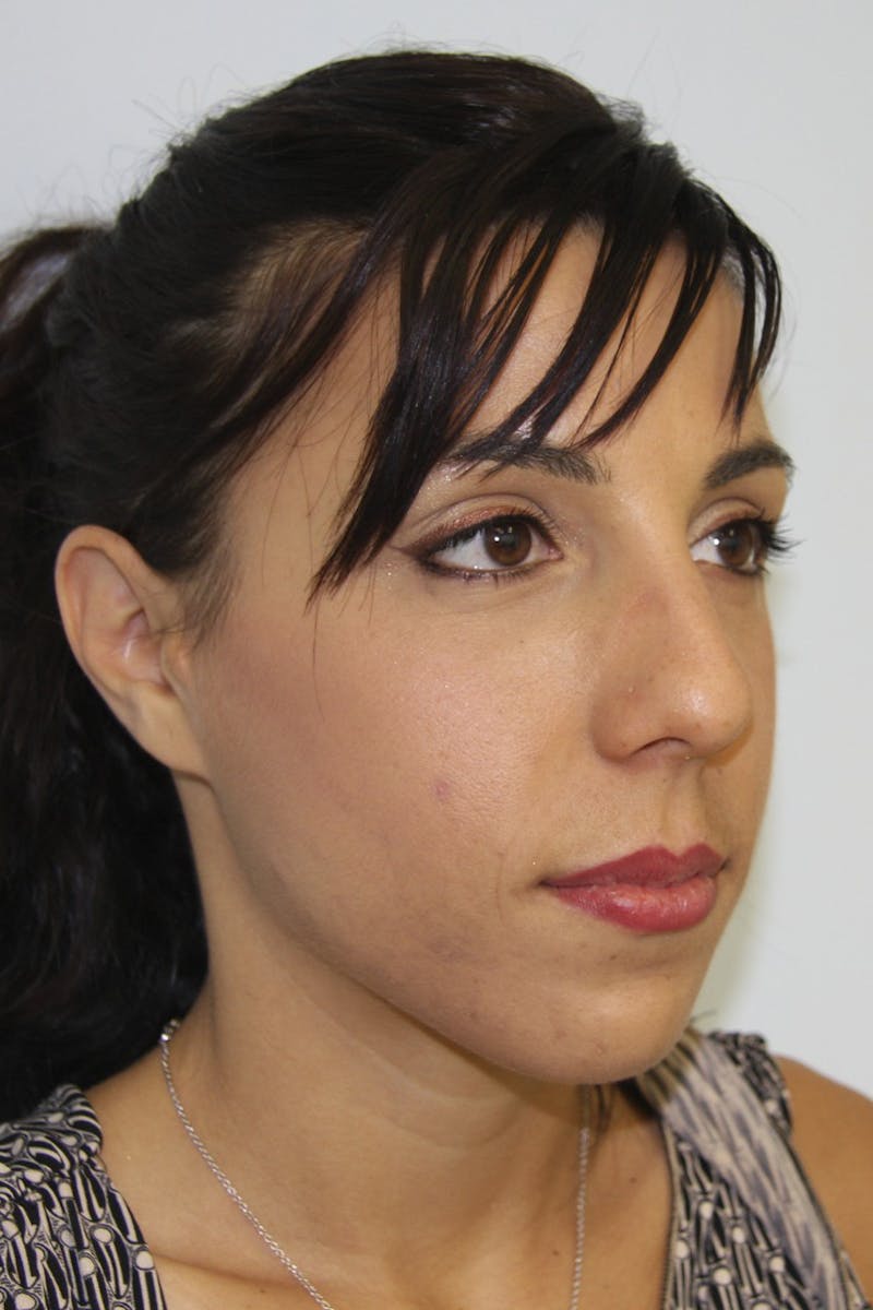 Chin Augmentation Before & After Gallery - Patient 143521924 - Image 5
