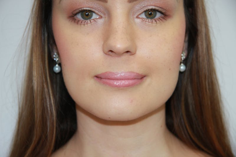 Mohs Reconstruction Before & After Gallery - Patient 143521920 - Image 2