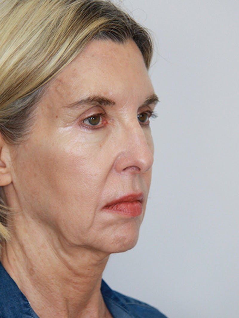 Facelift & Neck Lift Before & After Gallery - Patient 143521927 - Image 3