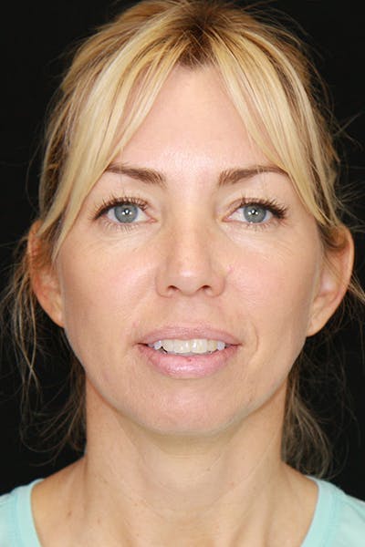 Sculptra Before & After Gallery - Patient 143521922 - Image 1