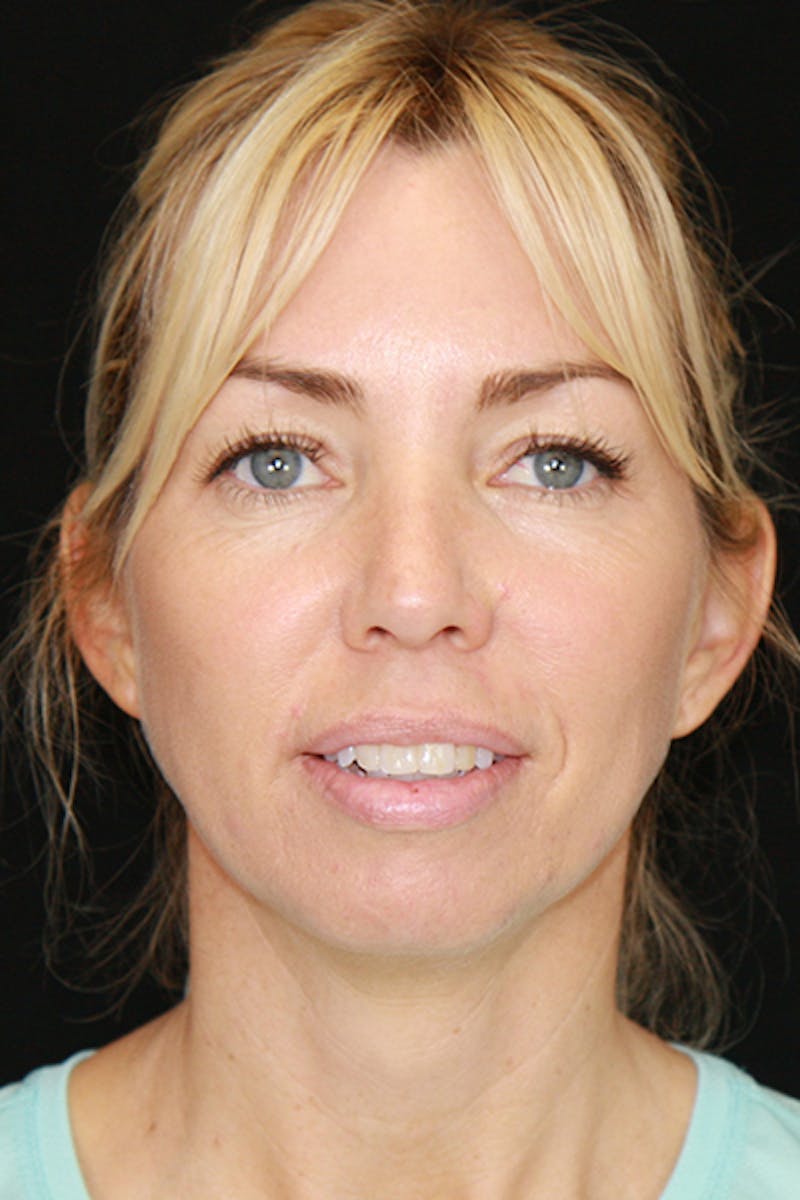 Sculptra Before & After Gallery - Patient 143521922 - Image 1