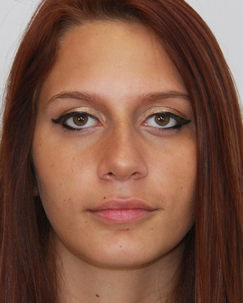 Rhinoplasty Before & After Gallery - Patient 143521929 - Image 2