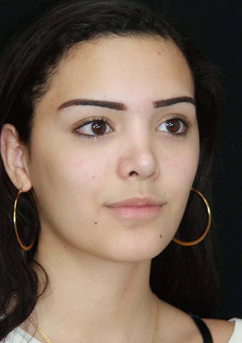 Non-Surgical Rhinoplasty Before & After Gallery - Patient 143521925 - Image 3
