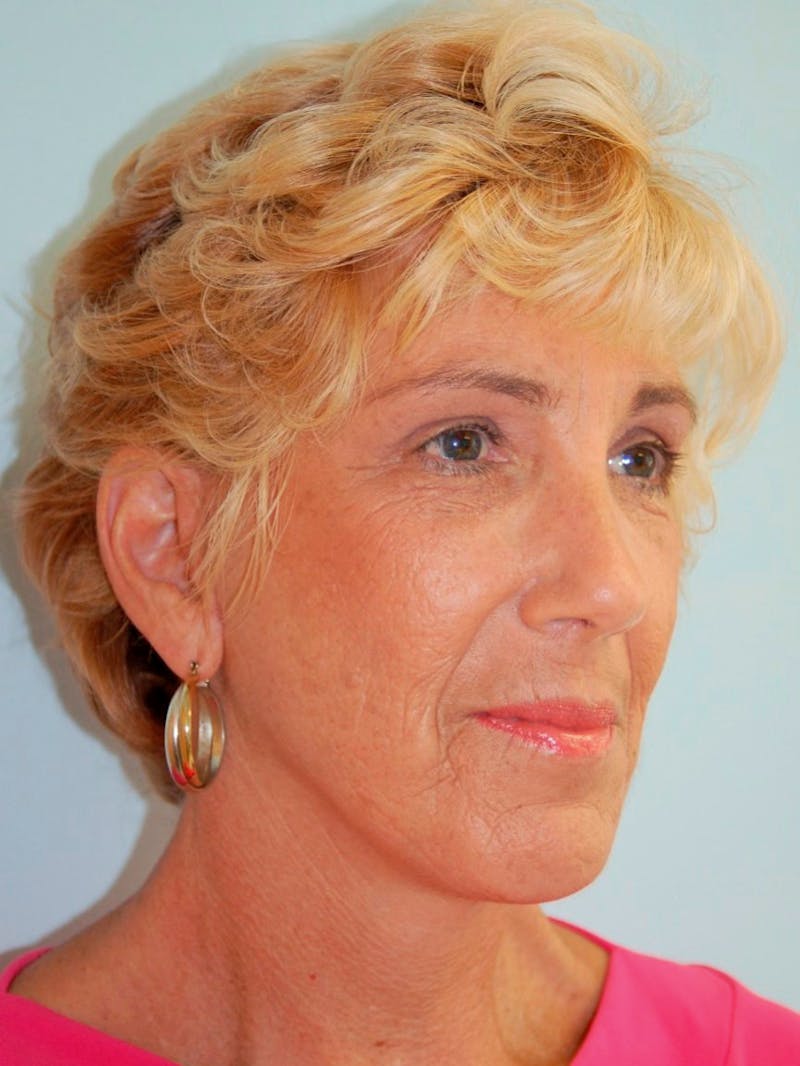 Eyelid Surgery Before & After Gallery - Patient 143521921 - Image 4