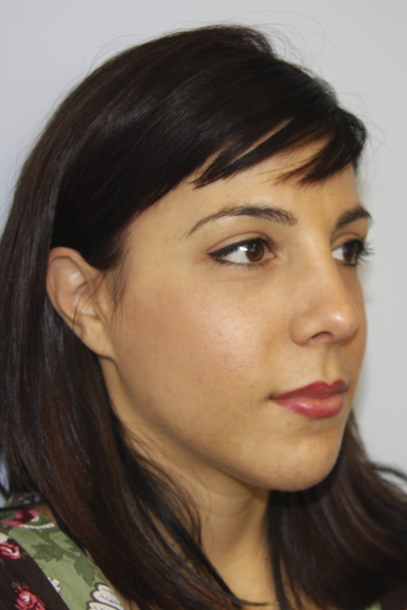 Chin Augmentation Before & After Gallery - Patient 143521924 - Image 6