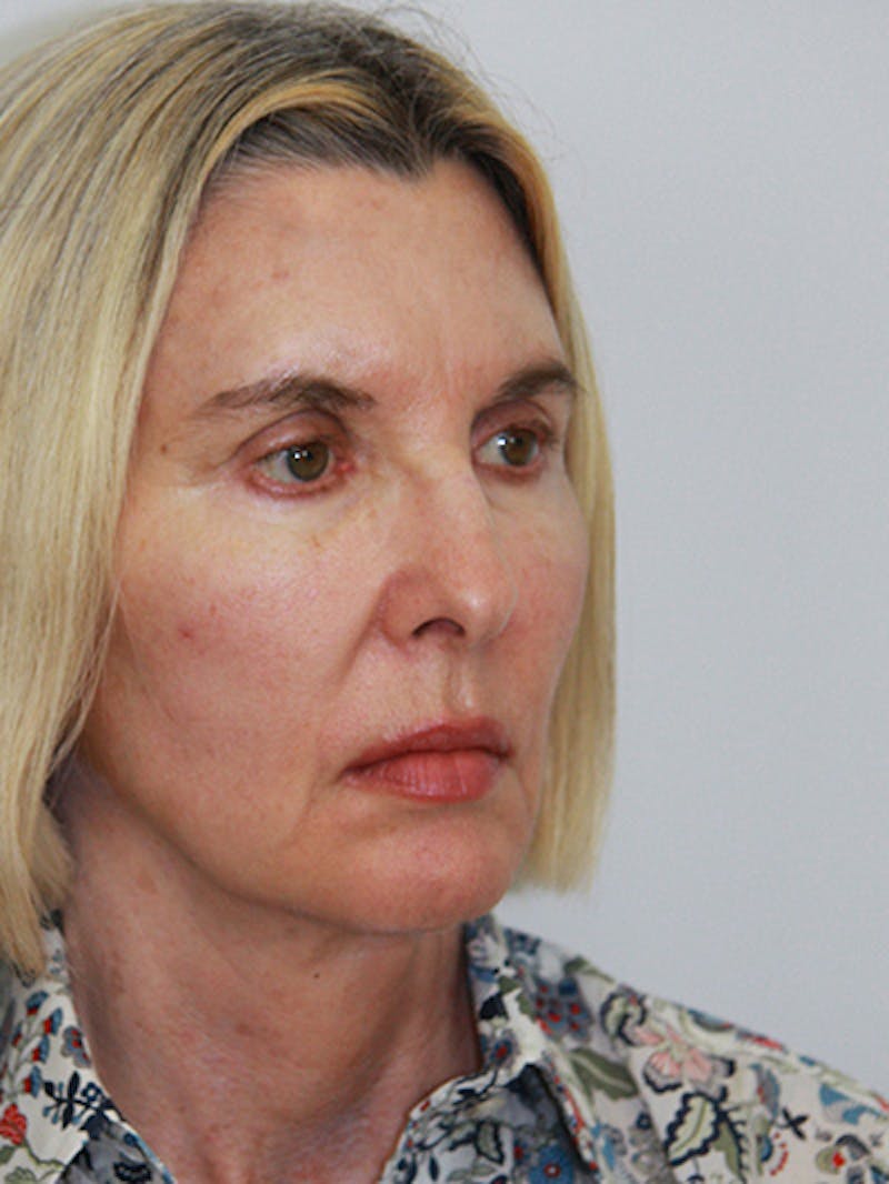Facelift & Neck Lift Before & After Gallery - Patient 143521927 - Image 4