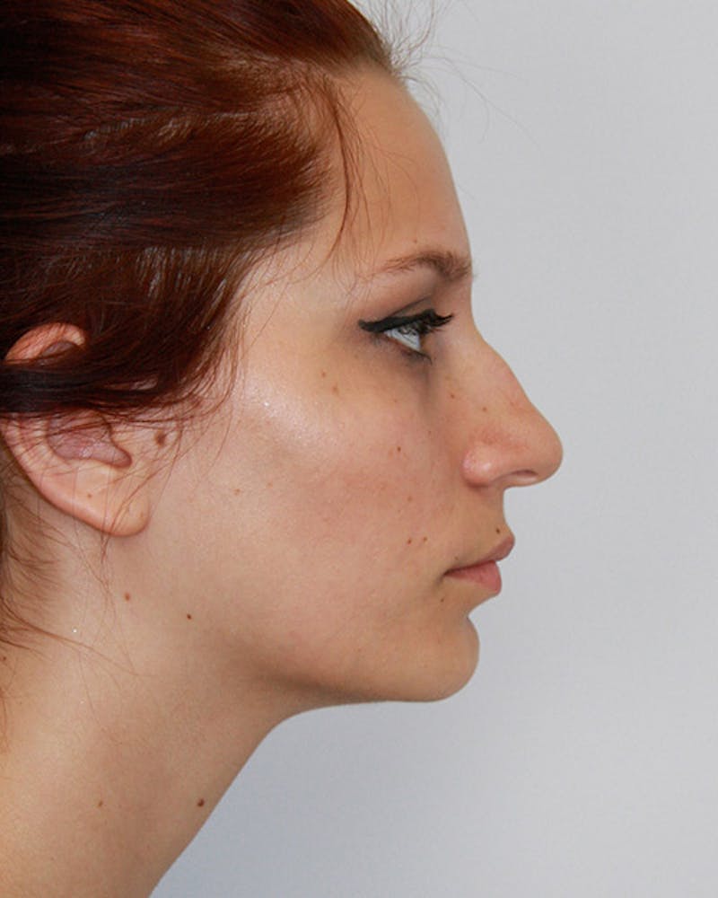 Rhinoplasty Before & After Gallery - Patient 143521929 - Image 3