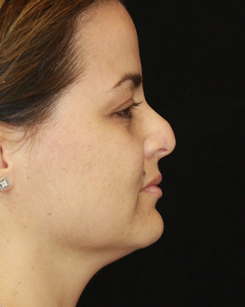 Revision Rhinoplasty Before & After Gallery - Patient 143521926 - Image 5