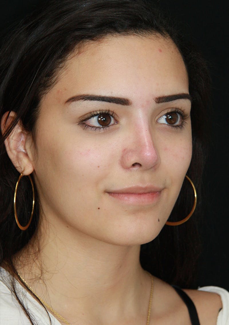 Non-Surgical Rhinoplasty Before & After Gallery - Patient 143521925 - Image 4