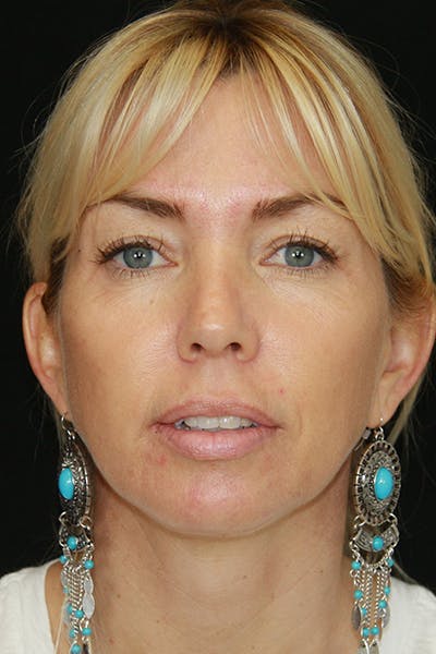 Sculptra Before & After Gallery - Patient 143521922 - Image 2