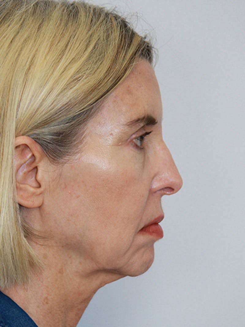 Facelift & Neck Lift Before & After Gallery - Patient 143521927 - Image 5