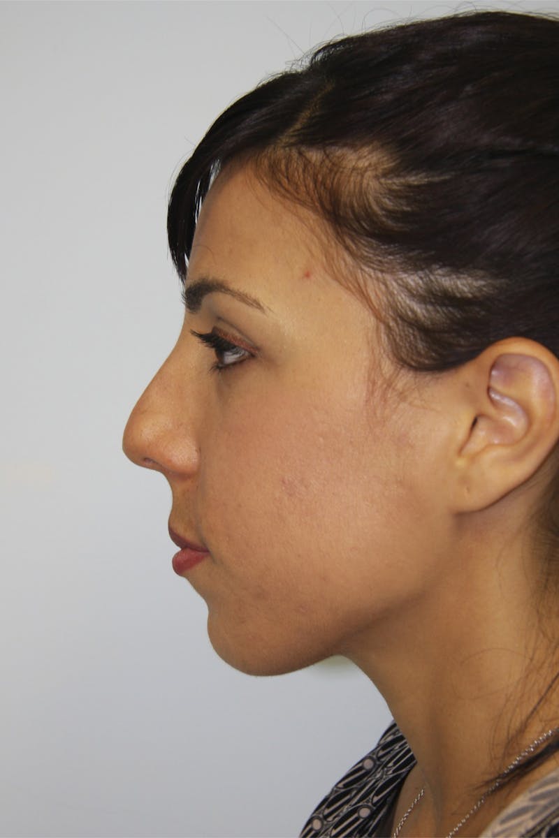 Chin Augmentation Before & After Gallery - Patient 143521924 - Image 7