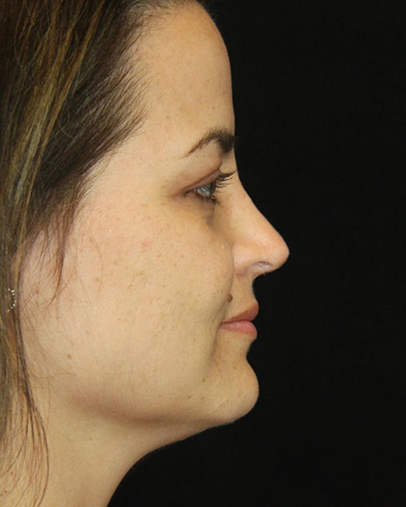 Revision Rhinoplasty Before & After Gallery - Patient 143521926 - Image 6