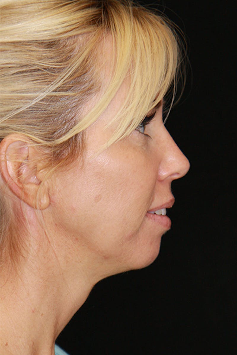 Sculptra Before & After Gallery - Patient 143521922 - Image 3