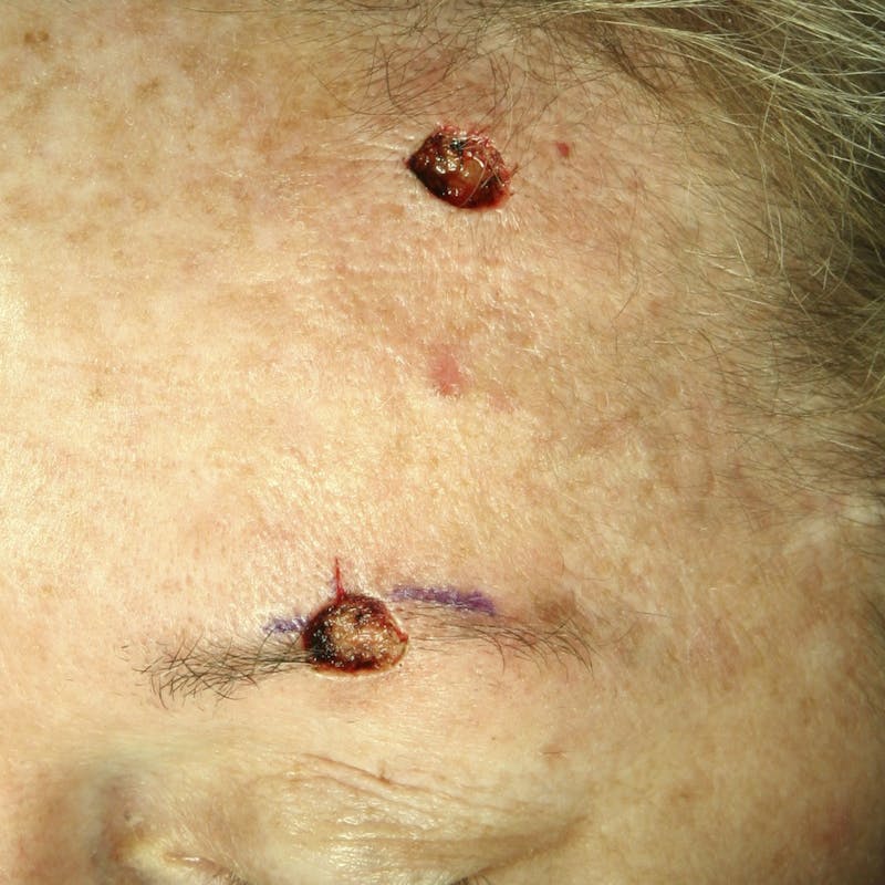 Mohs Reconstruction Before & After Gallery - Patient 143521923 - Image 1