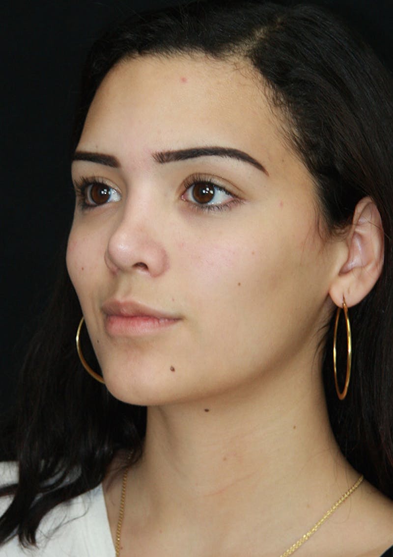 Non-Surgical Rhinoplasty Before & After Gallery - Patient 143521925 - Image 5