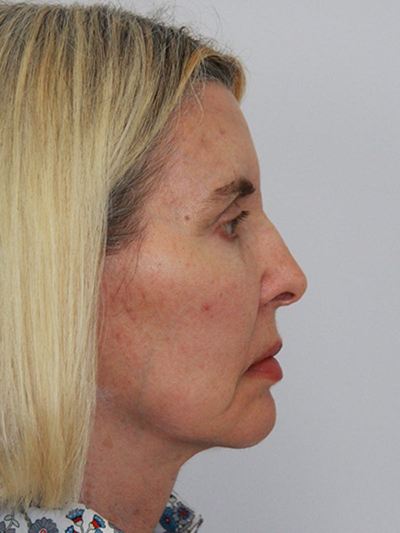 Facelift & Neck Lift Before & After Gallery - Patient 143521927 - Image 6
