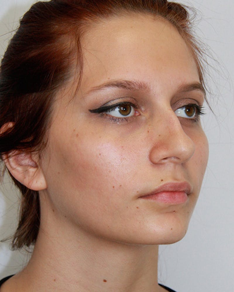 Rhinoplasty Before & After Gallery - Patient 143521929 - Image 5