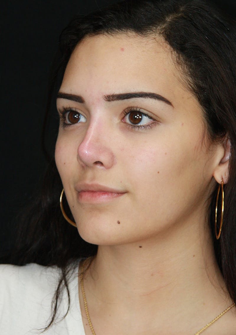 Non-Surgical Rhinoplasty Before & After Gallery - Patient 143521925 - Image 6