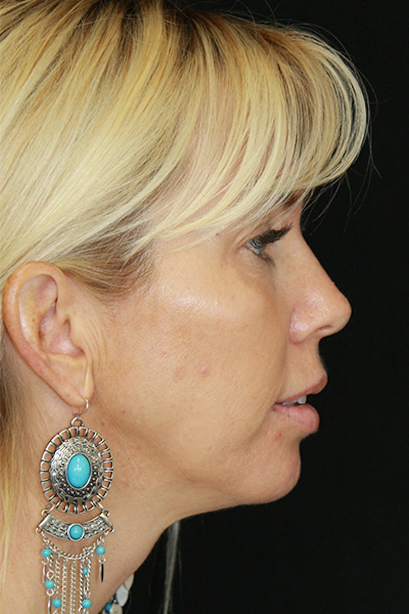 Sculptra Before & After Gallery - Patient 143521922 - Image 4