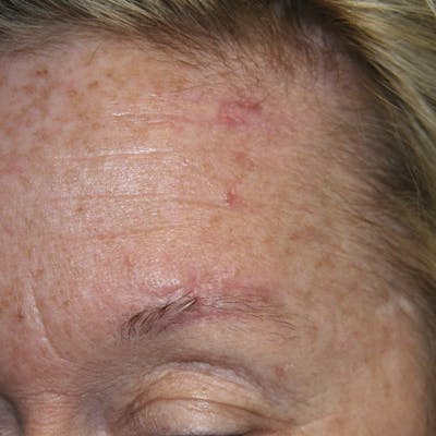 Mohs Reconstruction Before & After Gallery - Patient 143521923 - Image 2