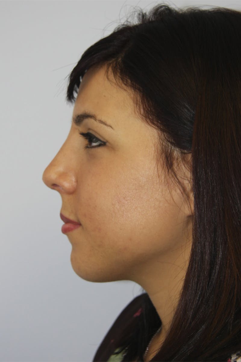 Chin Augmentation Before & After Gallery - Patient 143521924 - Image 8
