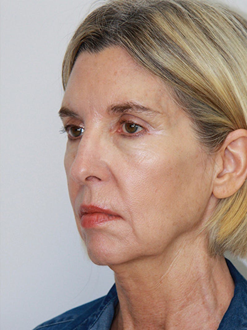 Facelift & Neck Lift Before & After Gallery - Patient 143521927 - Image 7