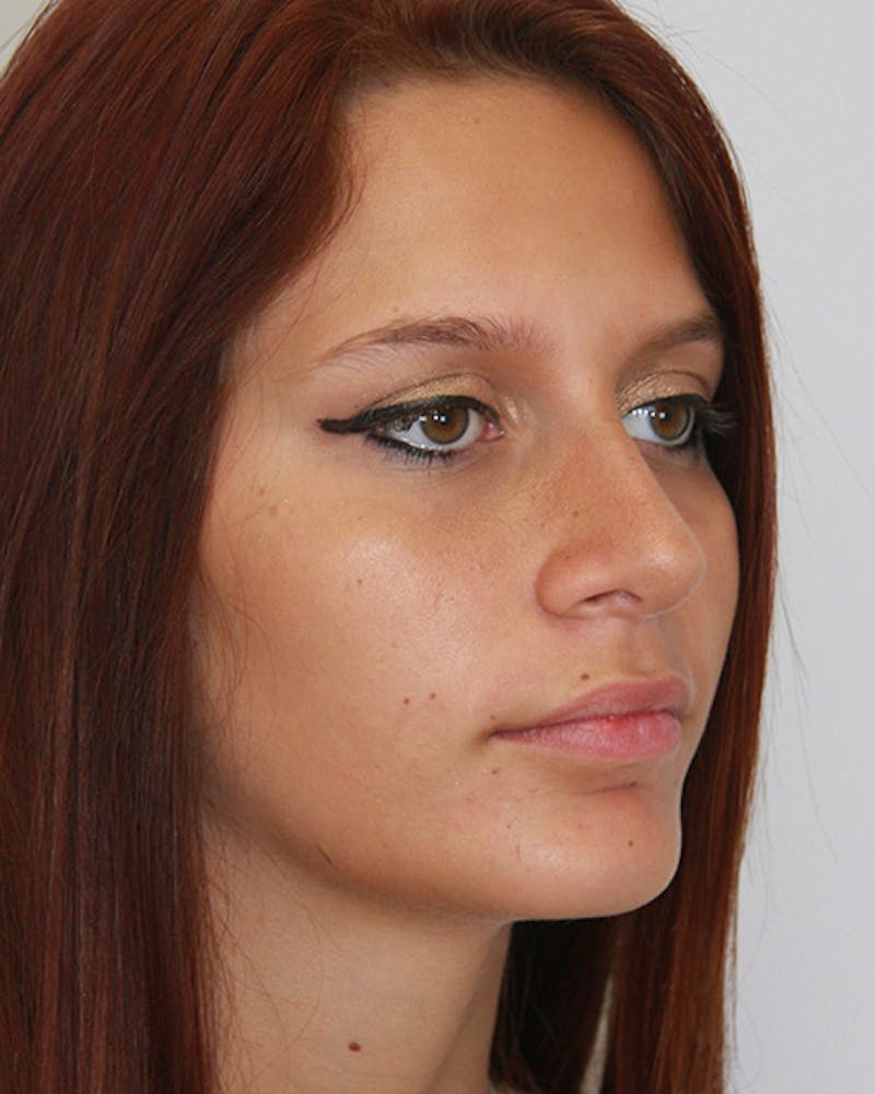Rhinoplasty Before & After Gallery - Patient 143521929 - Image 6