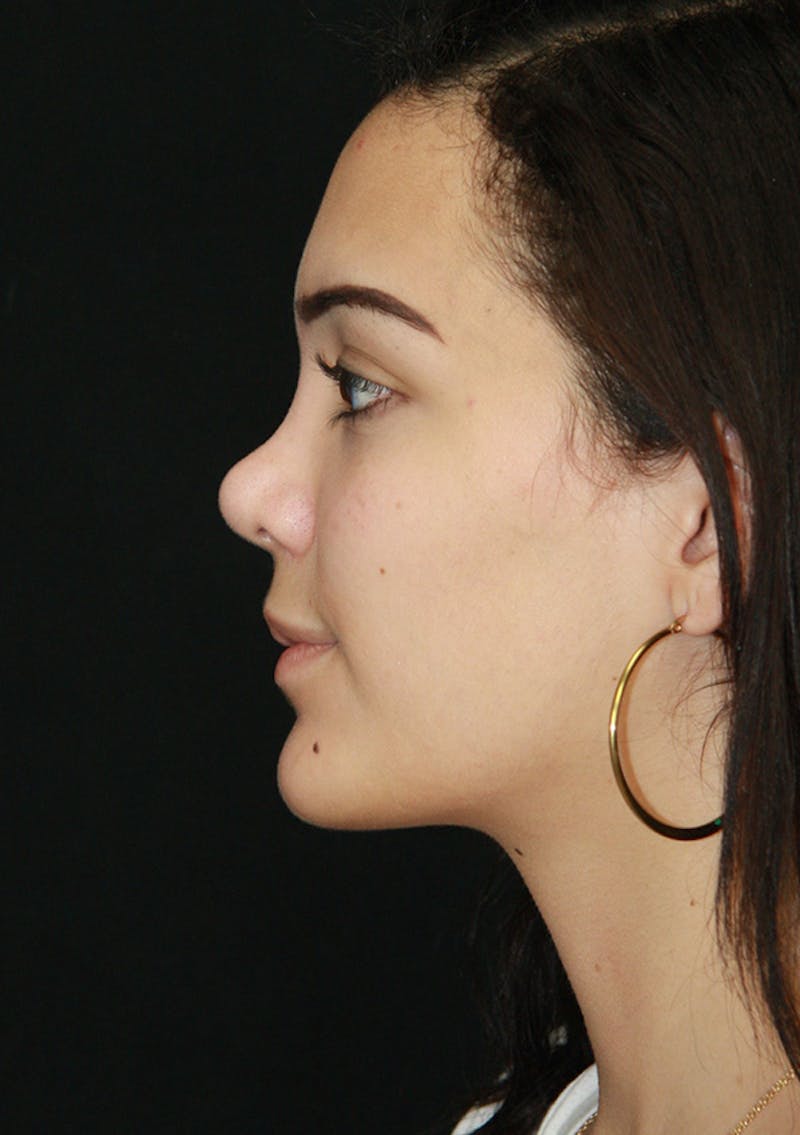 Non-Surgical Rhinoplasty Before & After Gallery - Patient 143521925 - Image 7