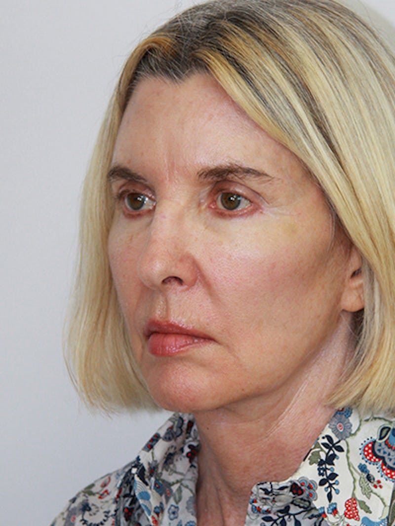Facelift & Neck Lift Before & After Gallery - Patient 143521927 - Image 8