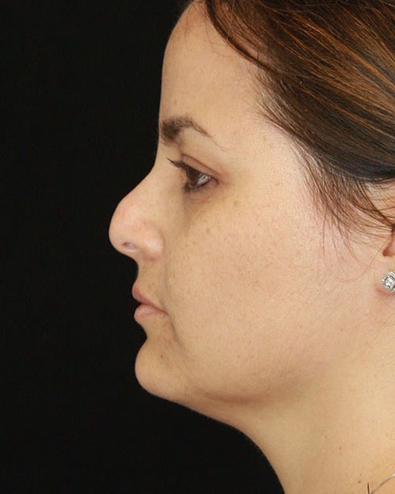 Revision Rhinoplasty Before & After Gallery - Patient 143521926 - Image 9