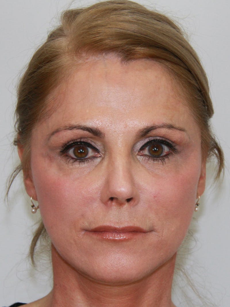 Eyelid Surgery Before & After Gallery - Patient 143521939 - Image 2