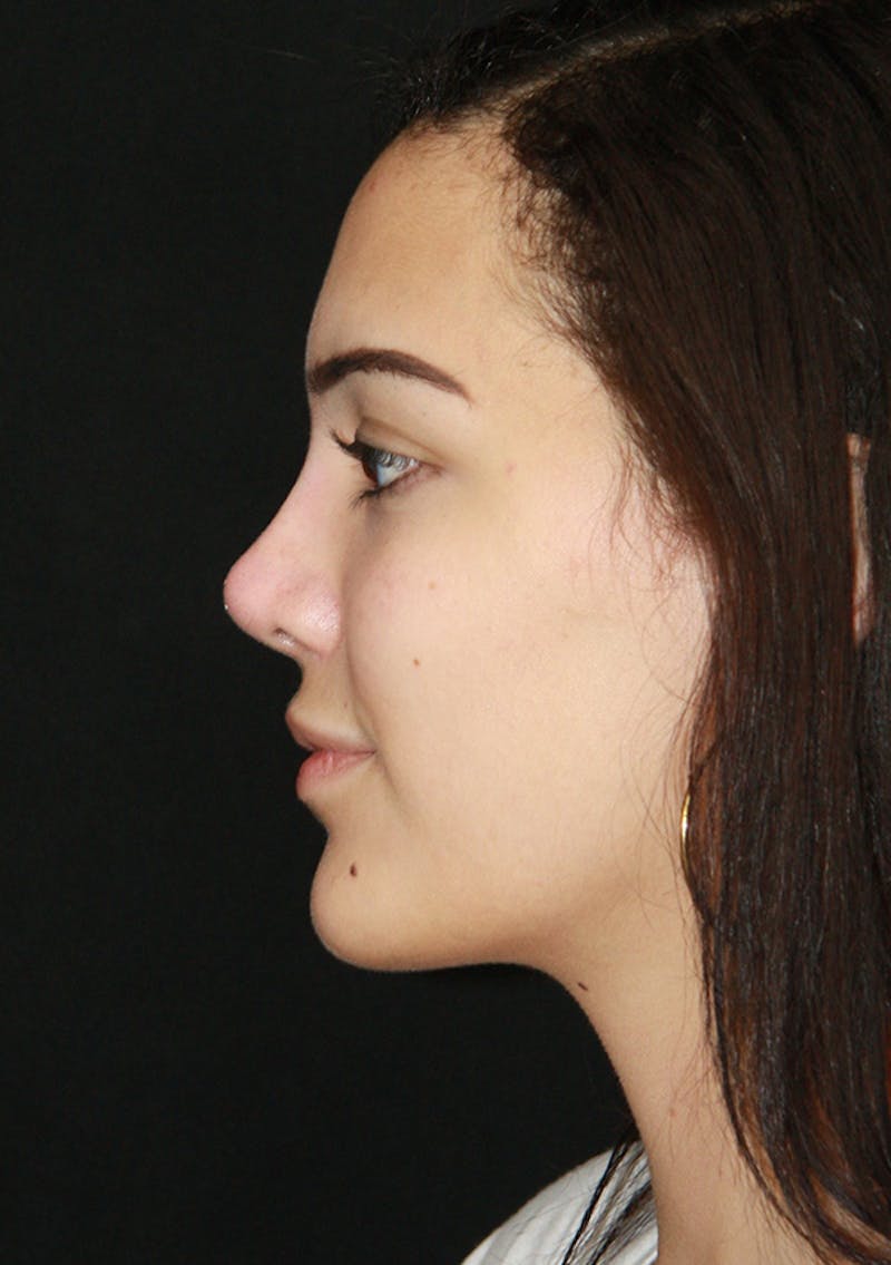 Non-Surgical Rhinoplasty Before & After Gallery - Patient 143521925 - Image 8