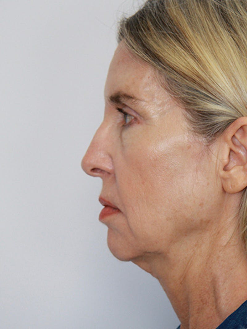 Facelift & Neck Lift Before & After Gallery - Patient 143521927 - Image 9