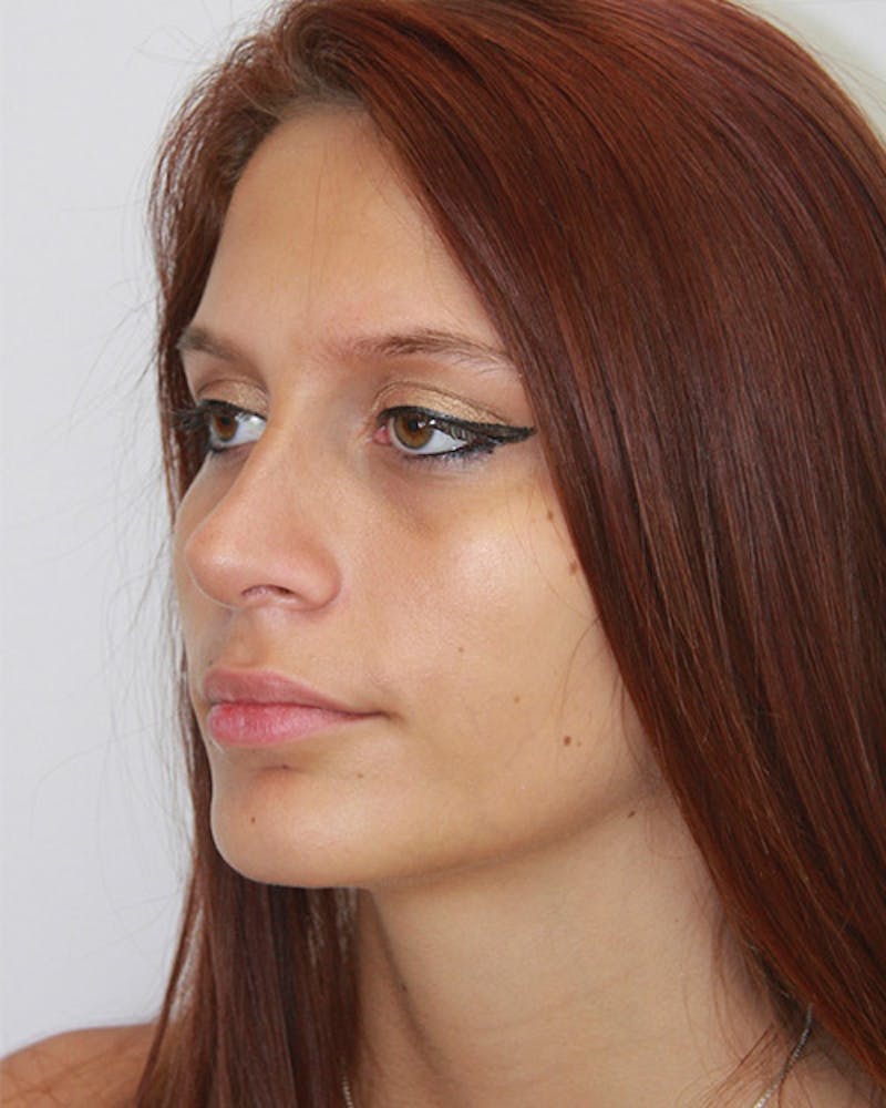 Rhinoplasty Before & After Gallery - Patient 143521929 - Image 8