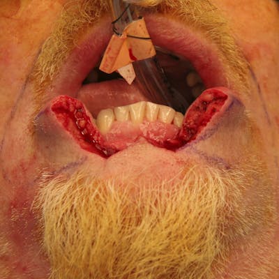 Mohs Reconstruction Before & After Gallery - Patient 143521928 - Image 1
