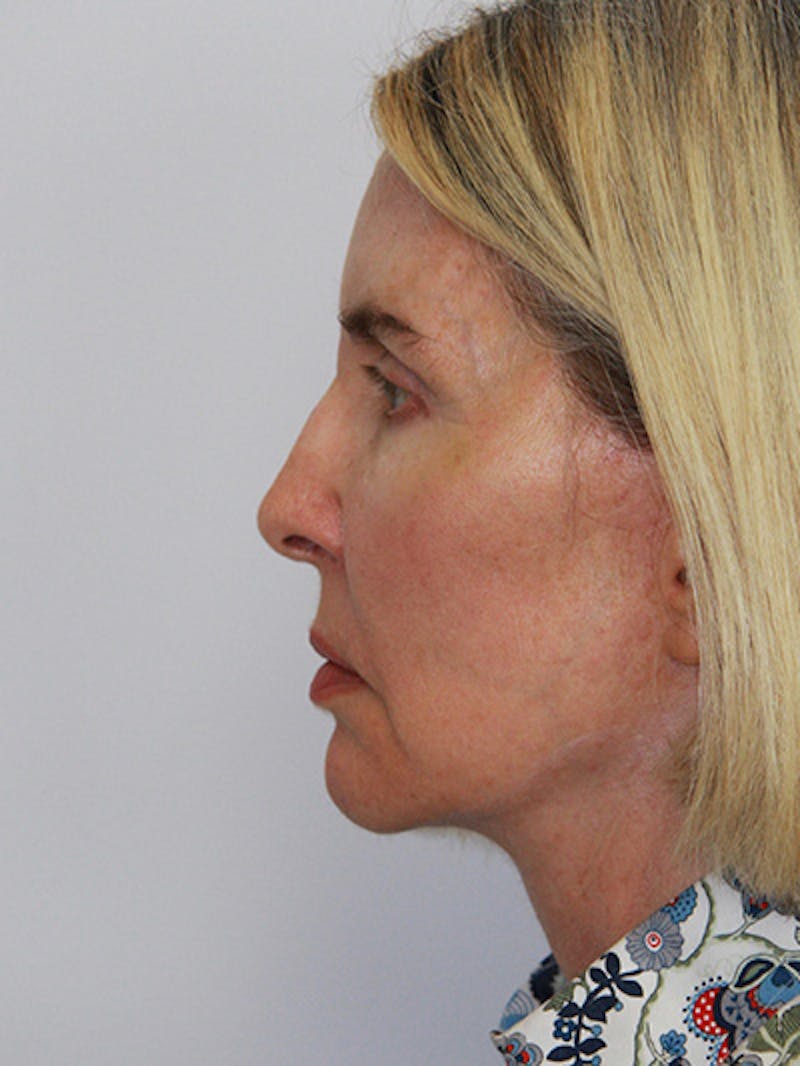 Facelift & Neck Lift Before & After Gallery - Patient 143521927 - Image 10