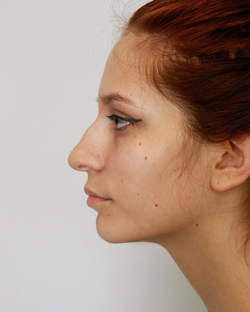 Rhinoplasty Before & After Gallery - Patient 143521929 - Image 9